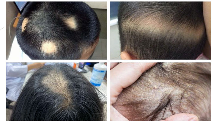 Nguyên nhân rụng tóc ở trẻ không do bệnh lý